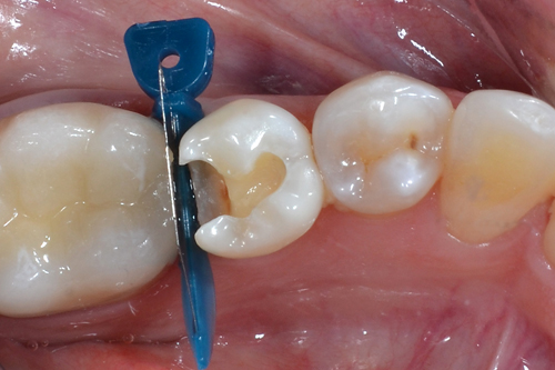 fogtömés fogorvos készítése