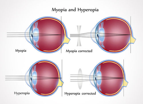 Myopia teszt online