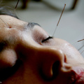 Van tapasztalata az akupunktúráról?