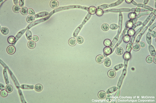 Candida albicans - a fehér mumus