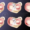 A meniscus sérülés 1. rész