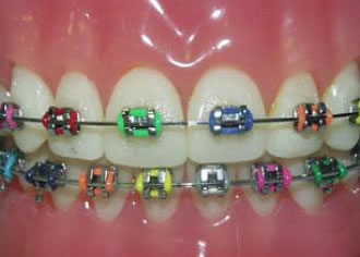 nhs-braces.jpg