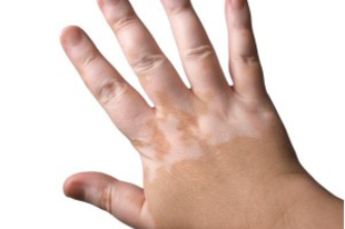 A vitiligo kezelése diétával, kristályokkal