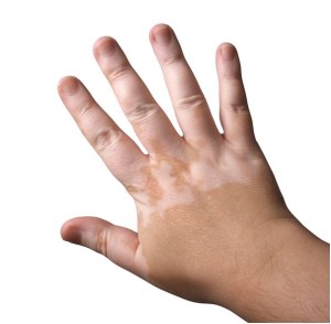 vitiligo1-300x294.jpg