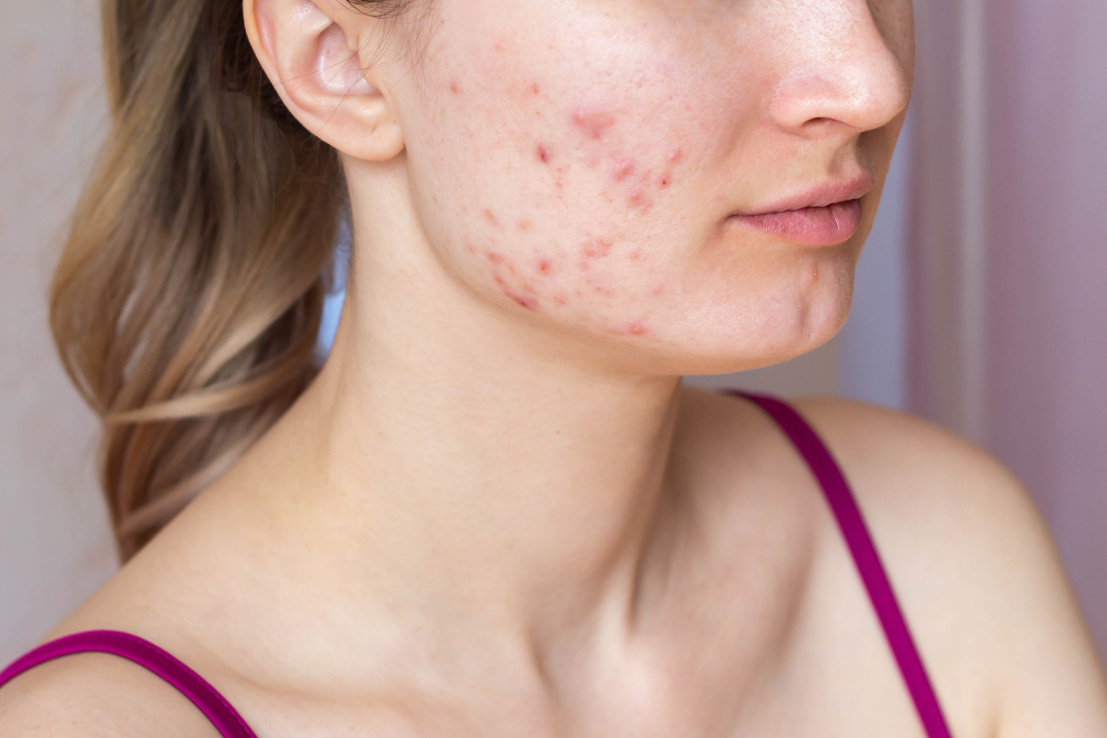 woman-face-problem-acne.jpg