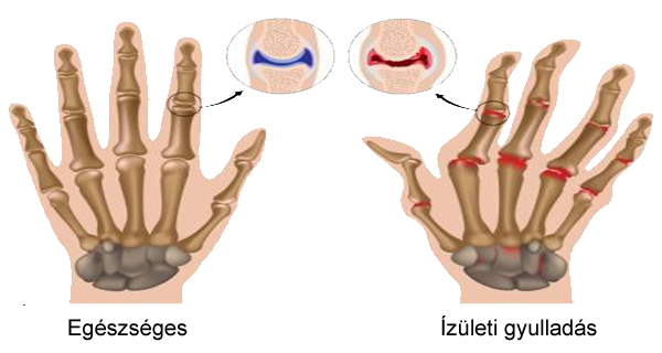 izuleti_gyulladas.jpg