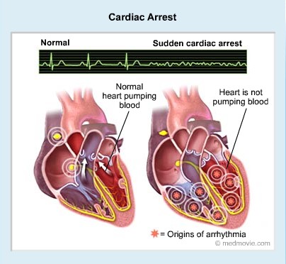 cardiac-arrest.jpg