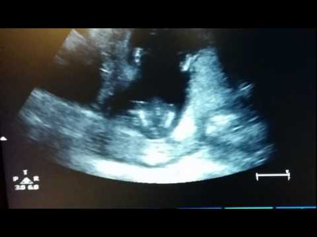 A anyuka és az orvos énekelnek, ultrahangon pedig a baba a pociban tapsol