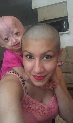 progeria.jpg