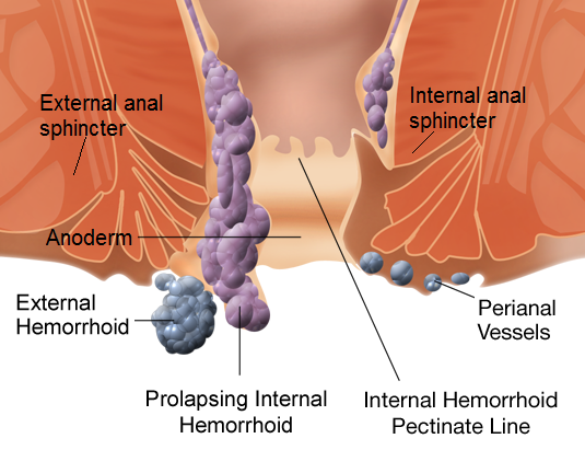 internal_and_external_hemorrhoids.png