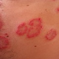Népbetegségek - Allergiás bőrgyulladások