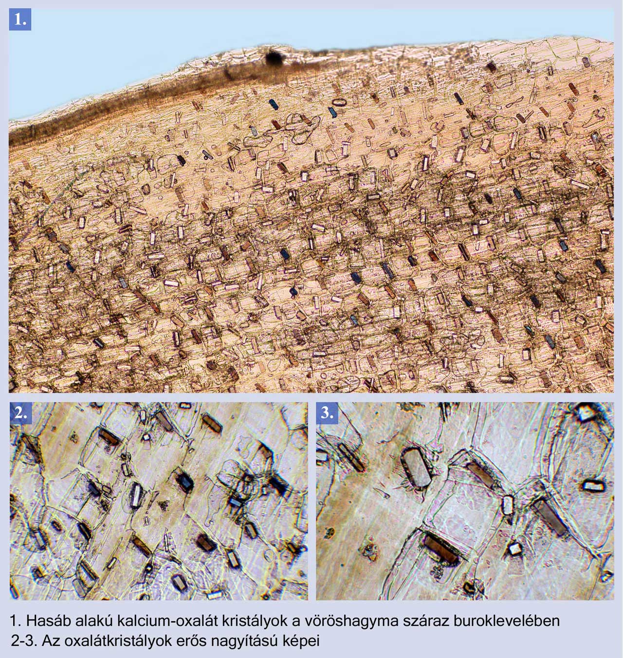 Kalcium-oxalát kristályok fénymikroszkópos vizsgálata