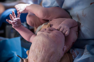 Csúcsfejű baba borzolja a kedélyeket, pedig ez nem ritka tünet a kisbabáknál