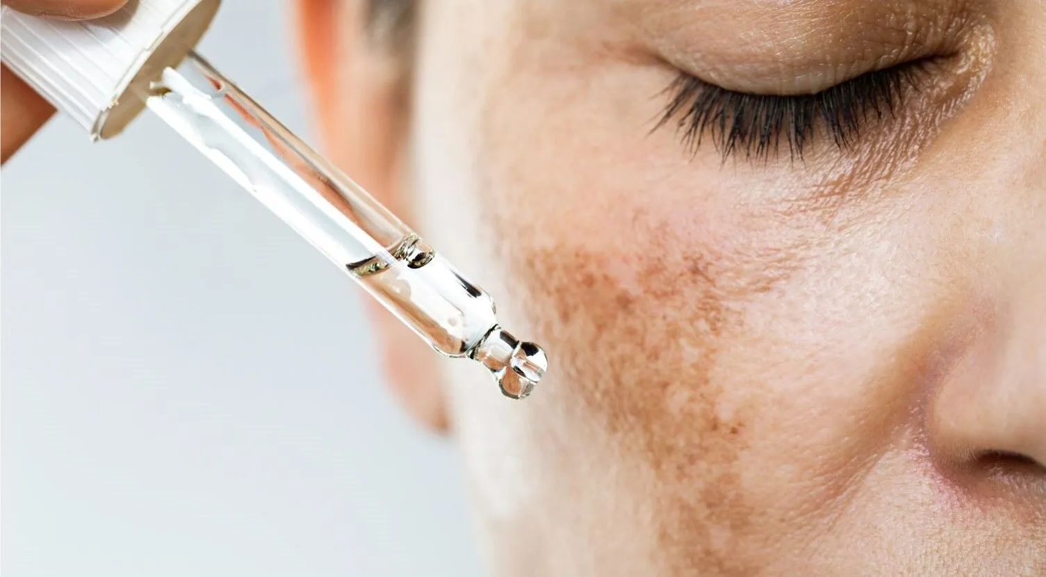 melasma.webp