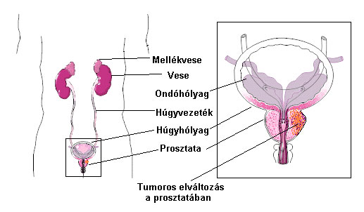prosztata_adenocarcinoma.jpg