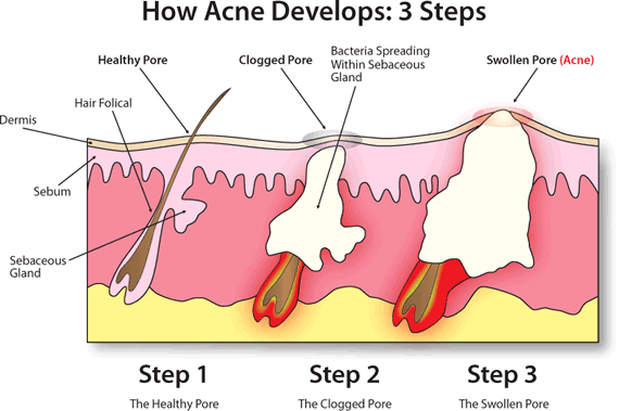 how-acne-develops.gif