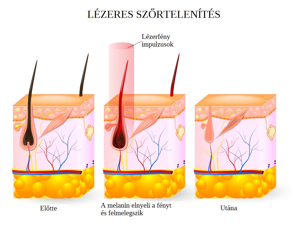 laser-hair-removal-services-in-buffalo-ny-smooth-solutions-med-e1446749245919.jpg