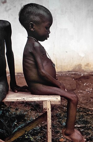 kwashiorkor.jpg