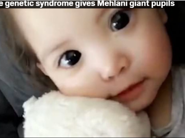 Genetikai betegség miatt hatalmasak egy kislány szemei, látása is veszélyben van