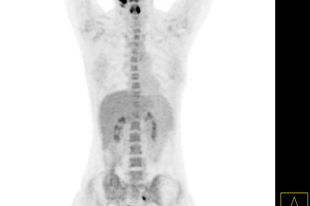 PET/CT eredmény