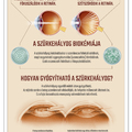 Infografika: 6 tény a szürkehályog kialakulásával kapcsolatban