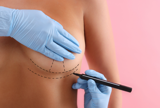 Tudtad? Mellplasztika után így viselkedik a hormonok hada