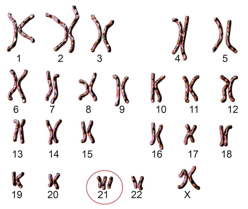 down-szindroma-kromoszomak-960x809.jpg