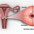 A méhnyakrákról (HPV)!