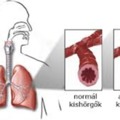 Asztma