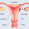 Hogyan gyógyultam ki az endometriózisból?