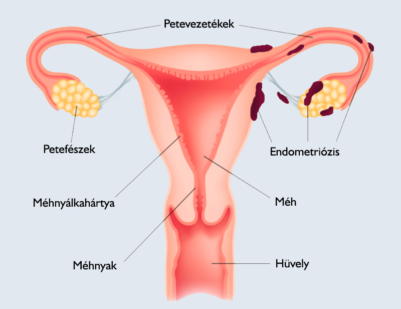 endometriozis-meh.jpg