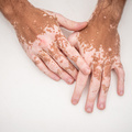 T1D és vitiligo