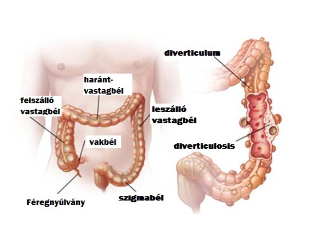 A diverticulosis és megelőzése