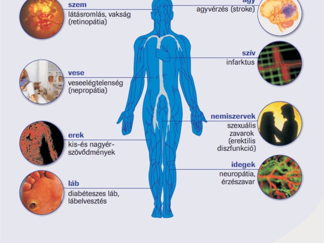 A cukorbetegség (2. rész) - Szövődmények