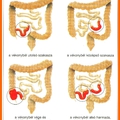 Gyulladásos bélbetegségek (IBD)