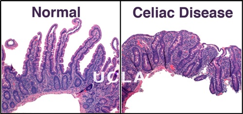 celiac_disease.jpg