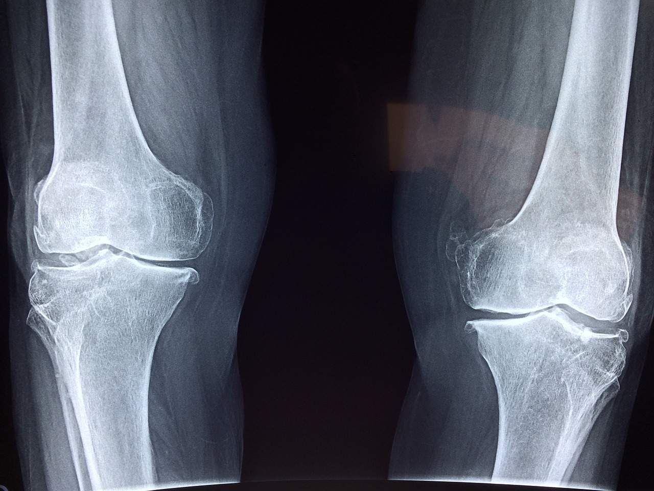 knee-2253047_1280.jpg