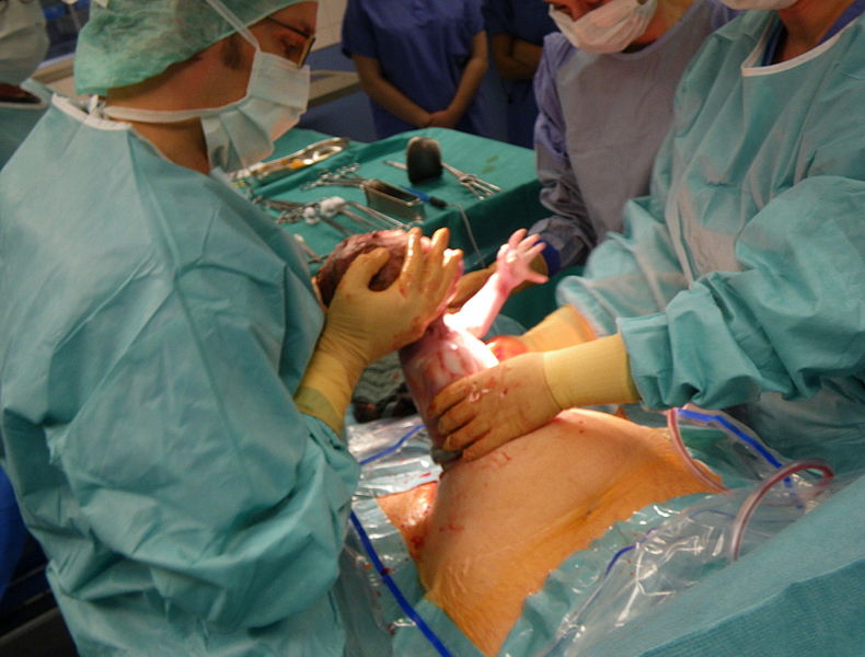 790px-Caesarian_section_-_Pull_out.jpg