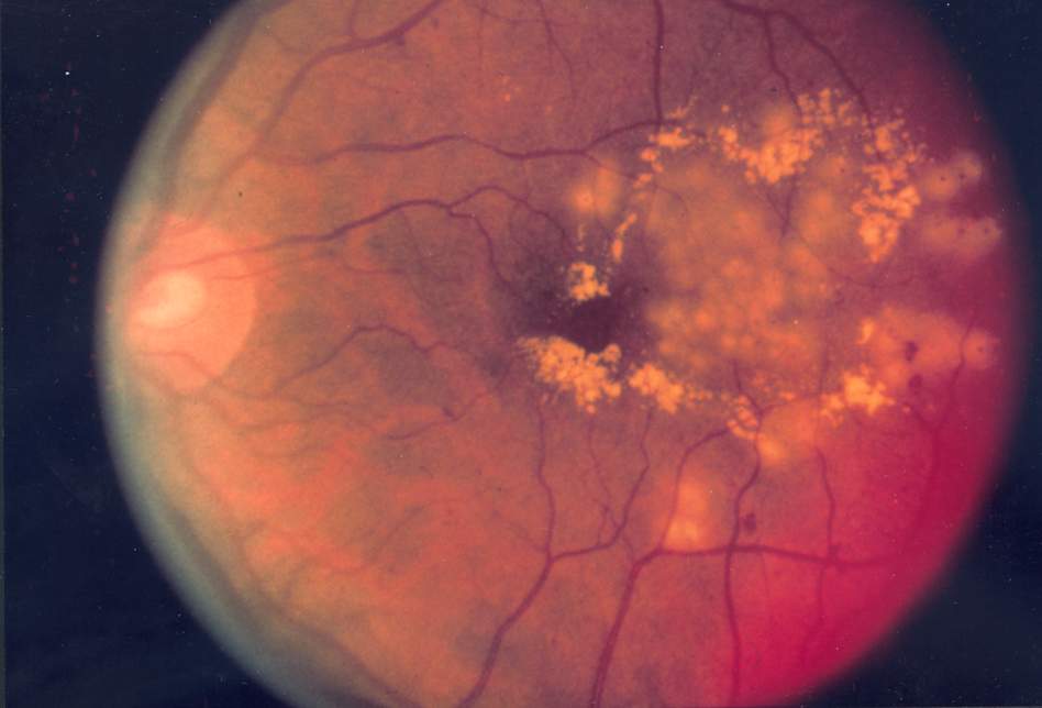 fundus_photo_showing_focal_laser_surgery_for_diabetic_retinopathy_eda10.JPG