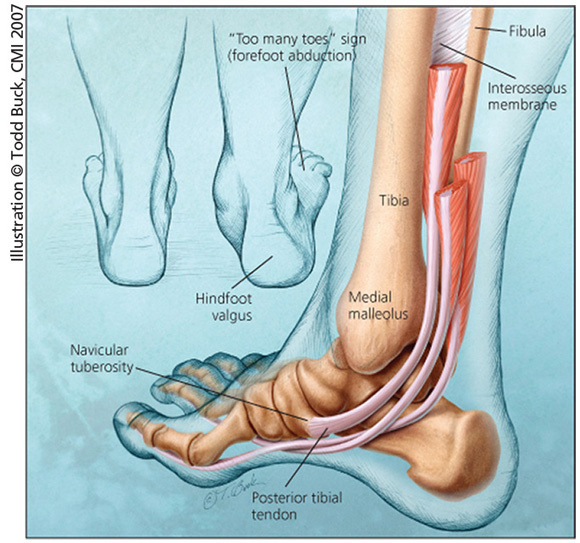 Posterior tibial tendon.jpg