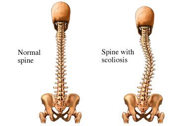 scoliosis.jpg