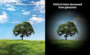glaukóma látásvesztés élesség és hyperopia