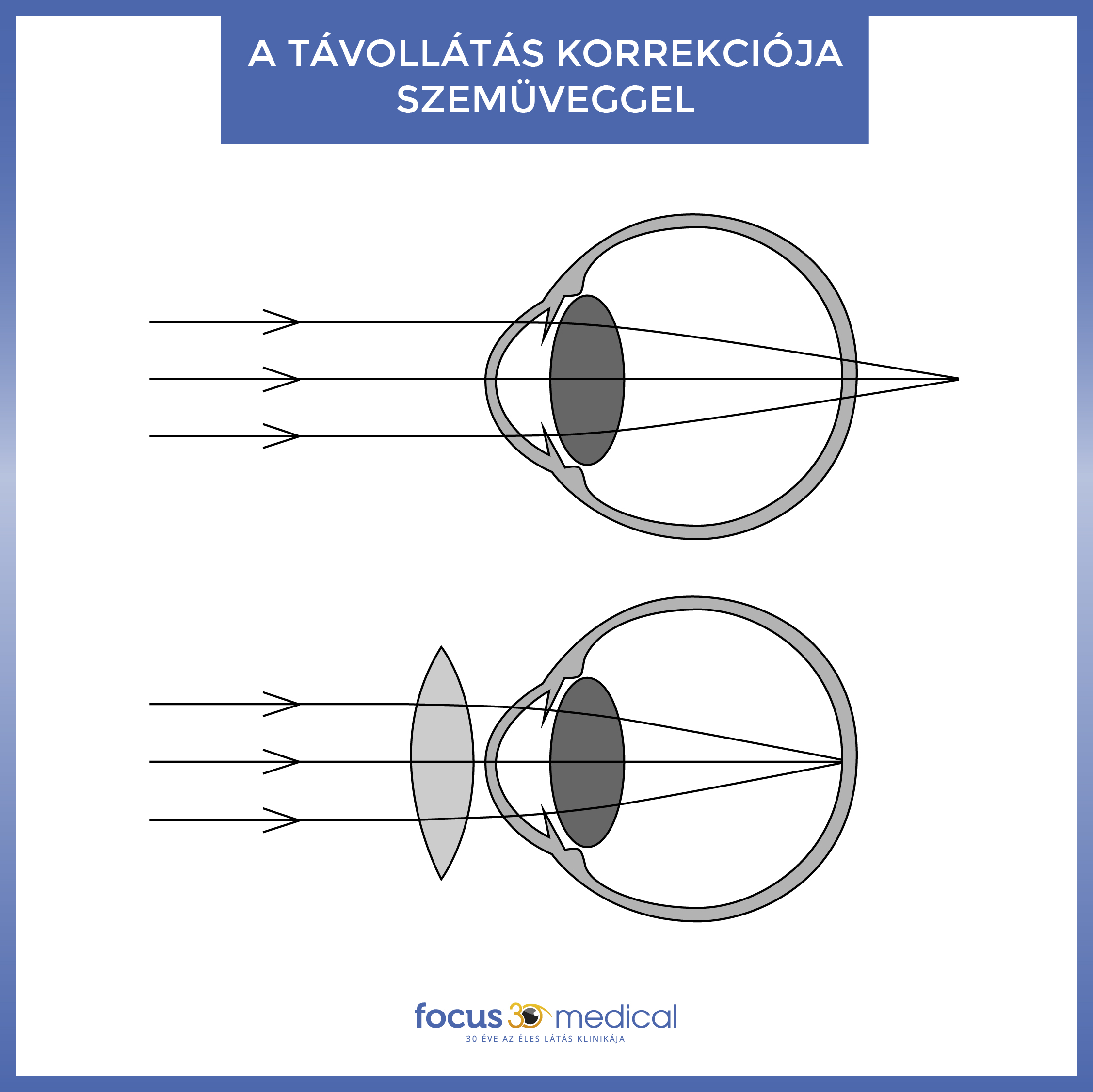 fm-a-tavollatas-korrekcioja-szemuveggel.jpg