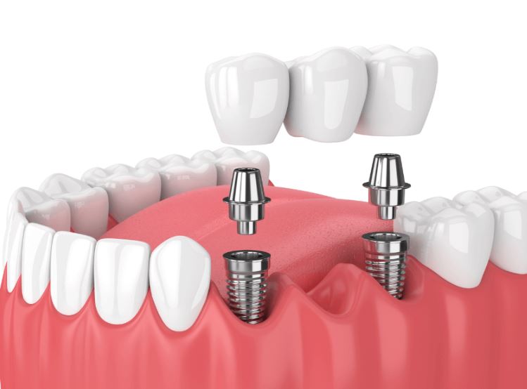 dental_implants_in_budapest_1.jpg