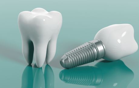 dental_implants_in_budapest_2.jpg