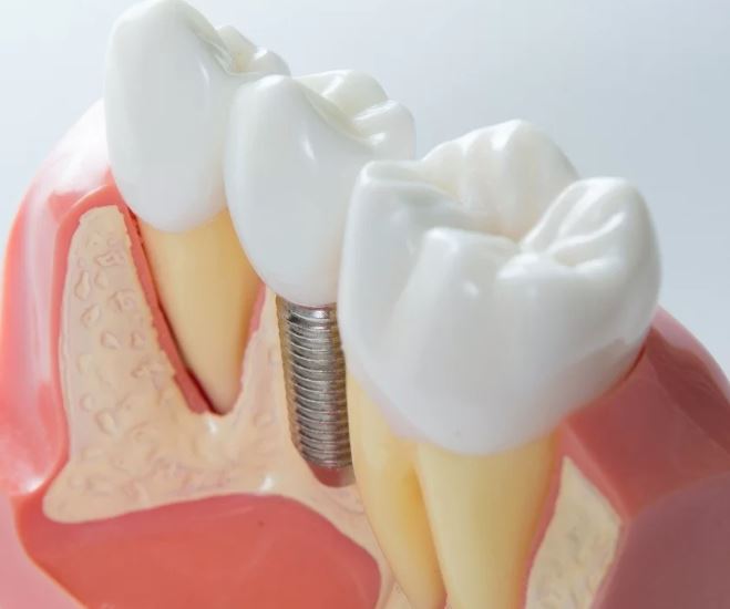 dental_implants_in_budapest_3.jpg