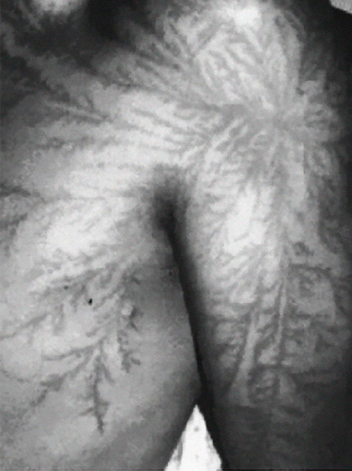 scars-after-surviving-lightning-strike-lichtenberg-figures-photos-16-5b6d31b9df3b3_700.jpg