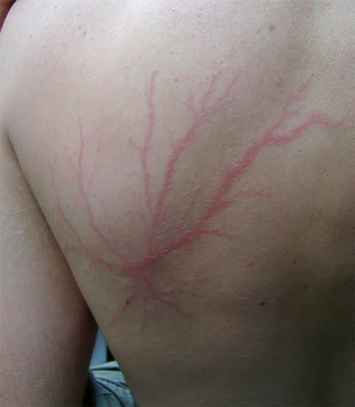 scars-after-surviving-lightning-strike-lichtenberg-figures-photos-5-5b6d30da68900_700.jpg