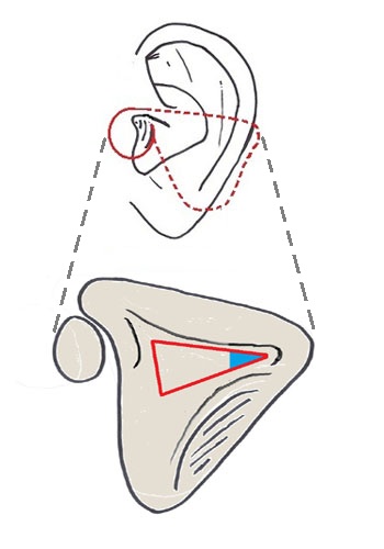 mastoidectomy - citelli angle - trautman triangle.jpg
