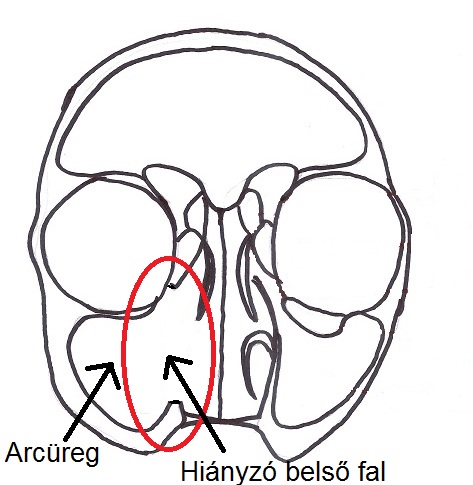 medial maxillectomy.jpg